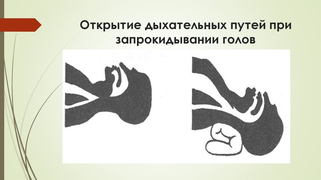 Открытие дыхательных путей при запрокидывании голов