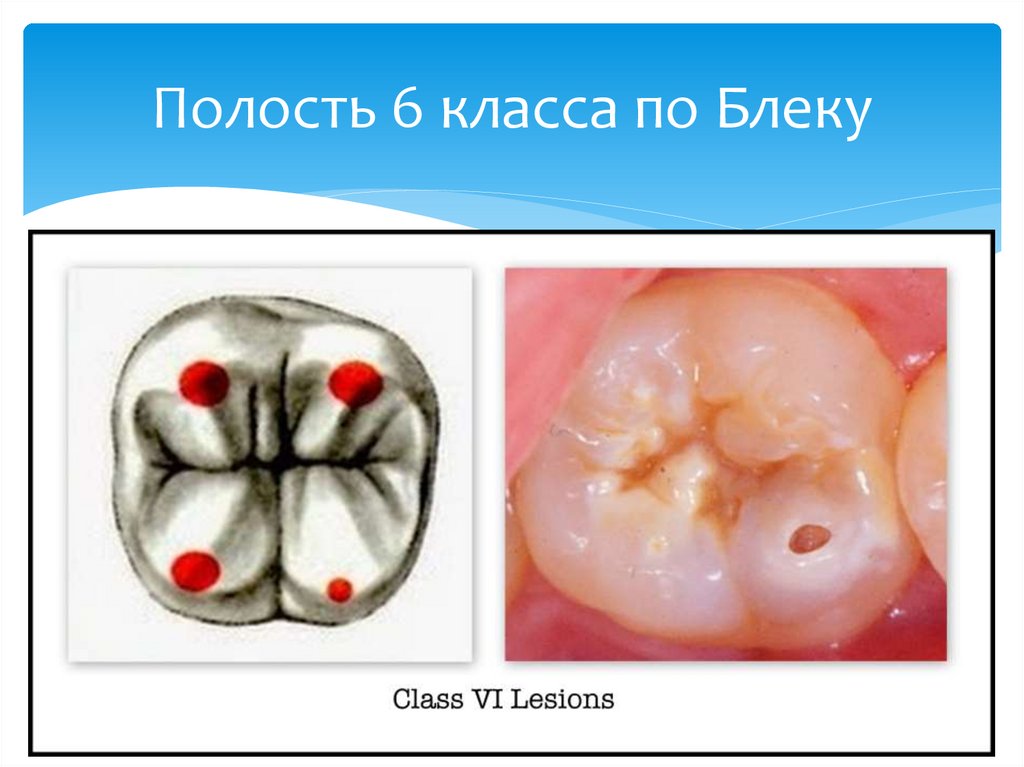 Полость 6 класса по Блеку