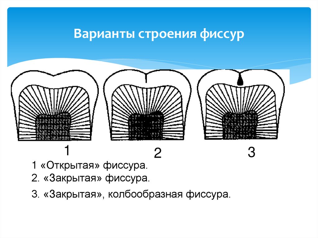 Варианты строения фиссур