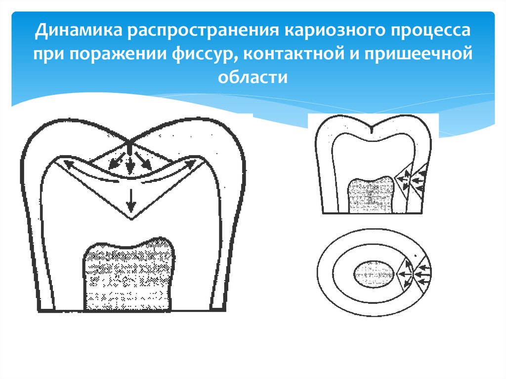 Динамика распространения кариозного процесса при поражении фиссур, контактной и пришеечной области