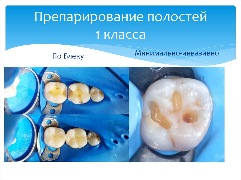 Препарирование полостей 1 класса