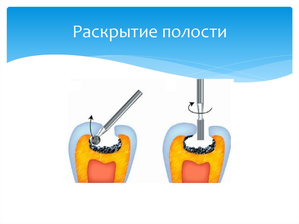 Раскрытие полости