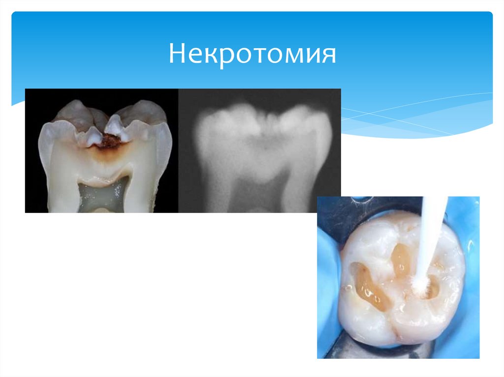 Некротомия