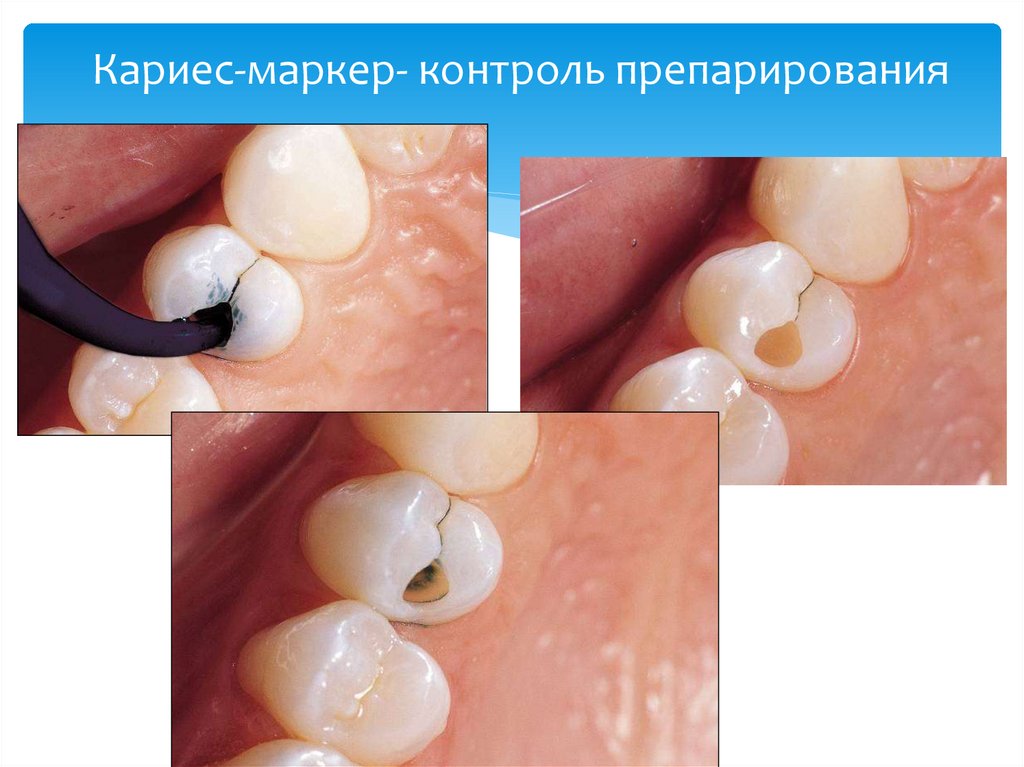 Кариес-маркер- контроль препарирования