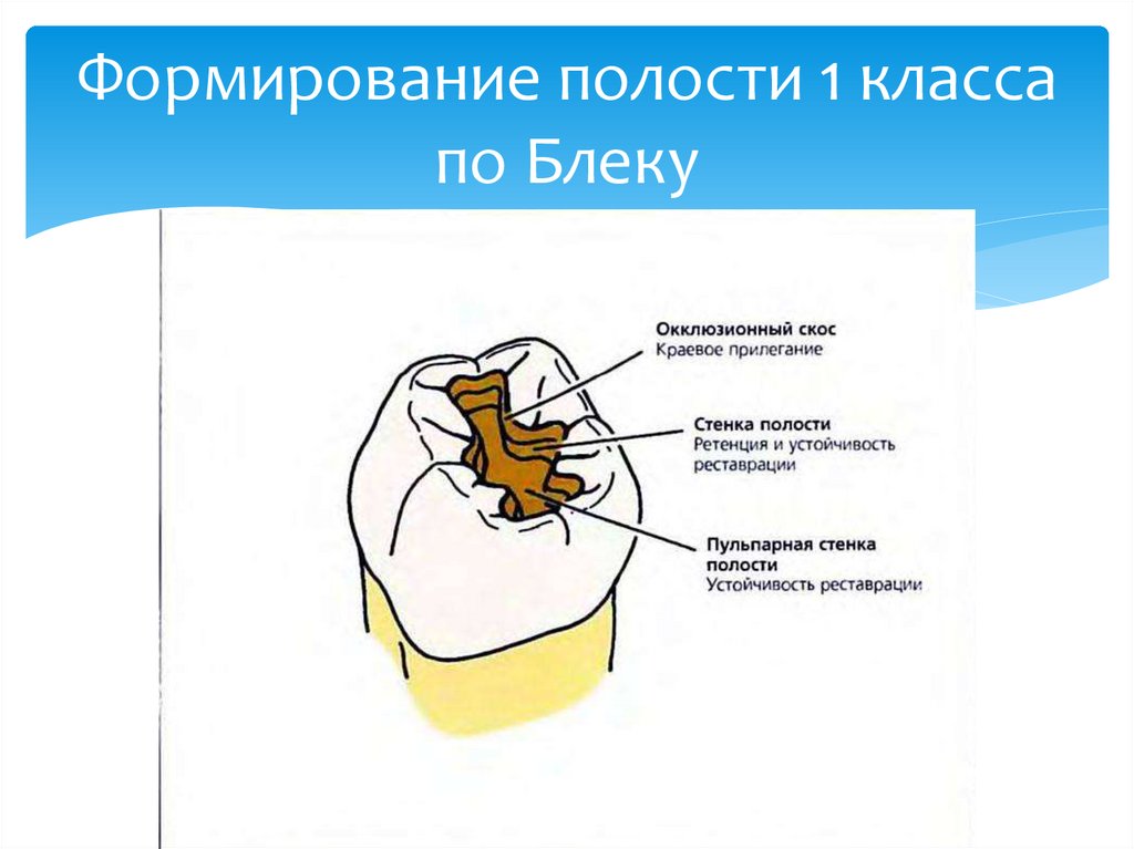 Формирование полости 1 класса по Блеку