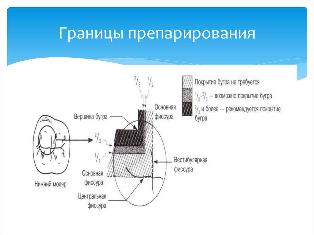 Границы препарирования