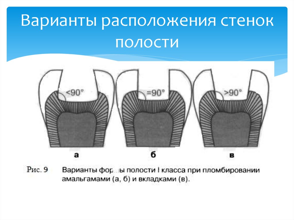 Варианты расположения стенок полости