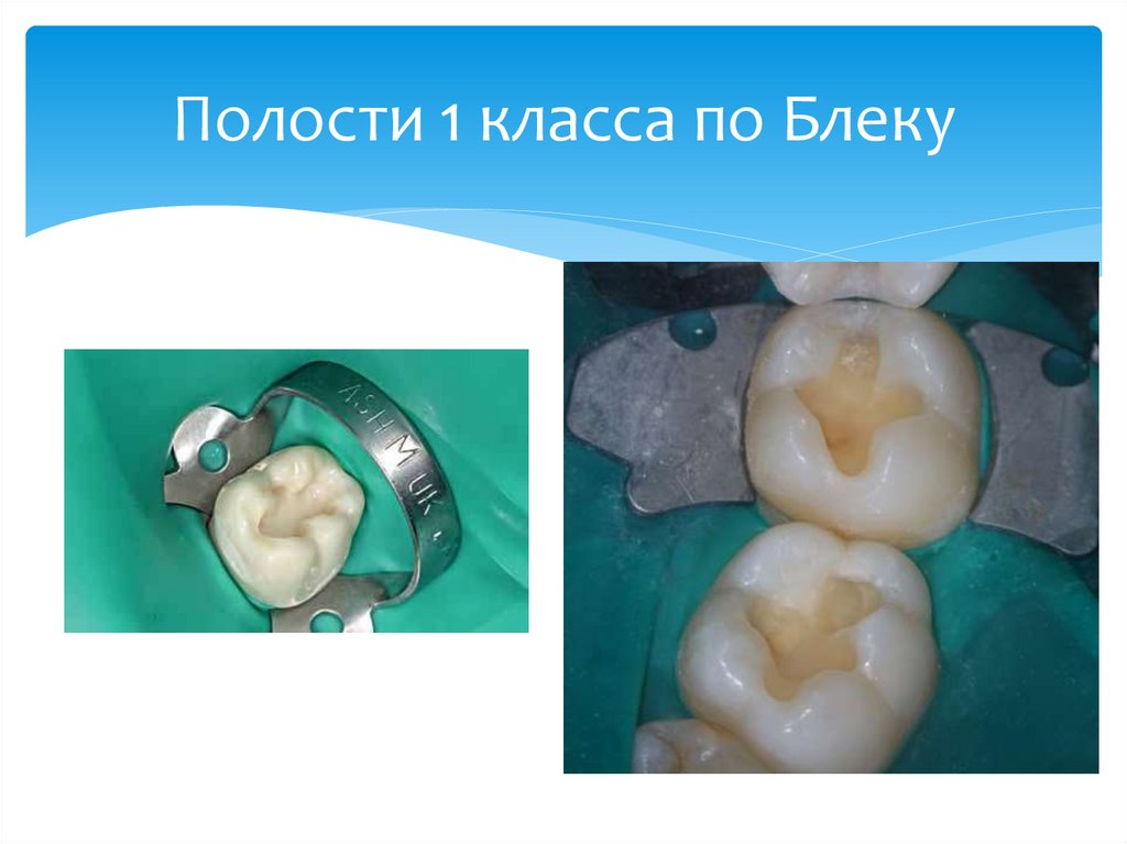 Полости 1 класса по Блеку