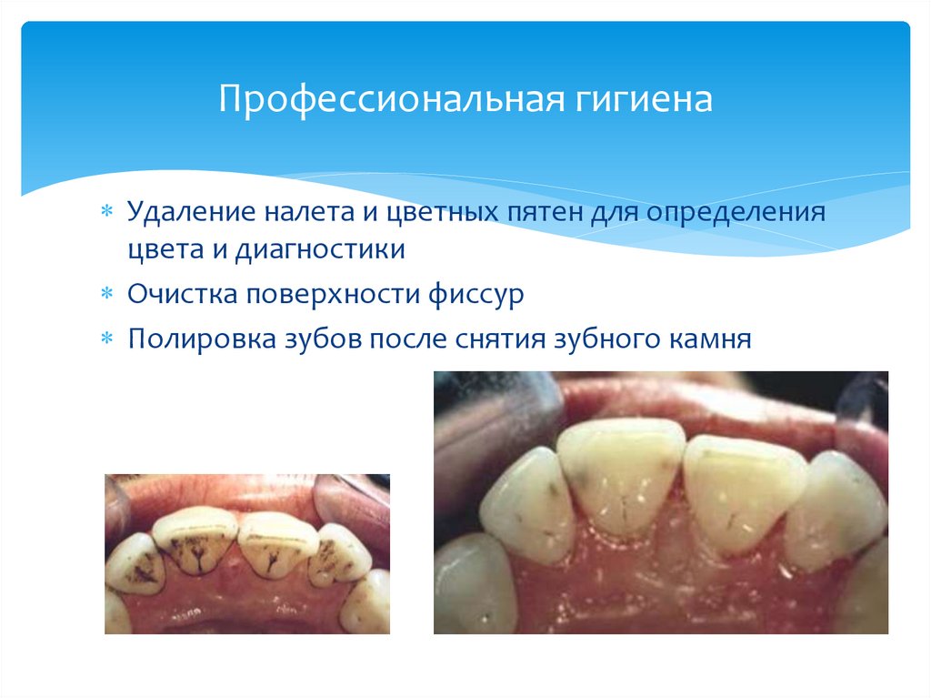 Профессиональная гигиена