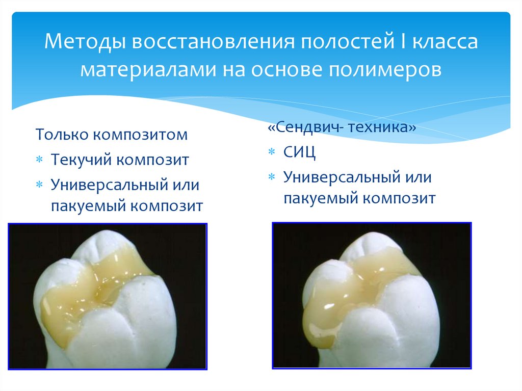 Методы восстановления полостей I класса материалами на основе полимеров