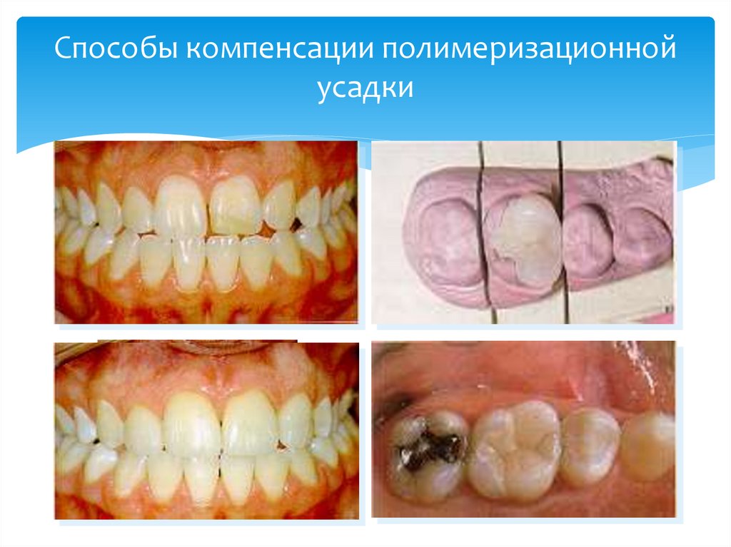 Способы компенсации полимеризационной усадки