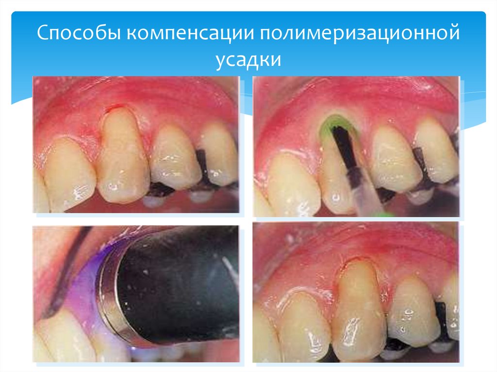 Способы компенсации полимеризационной усадки