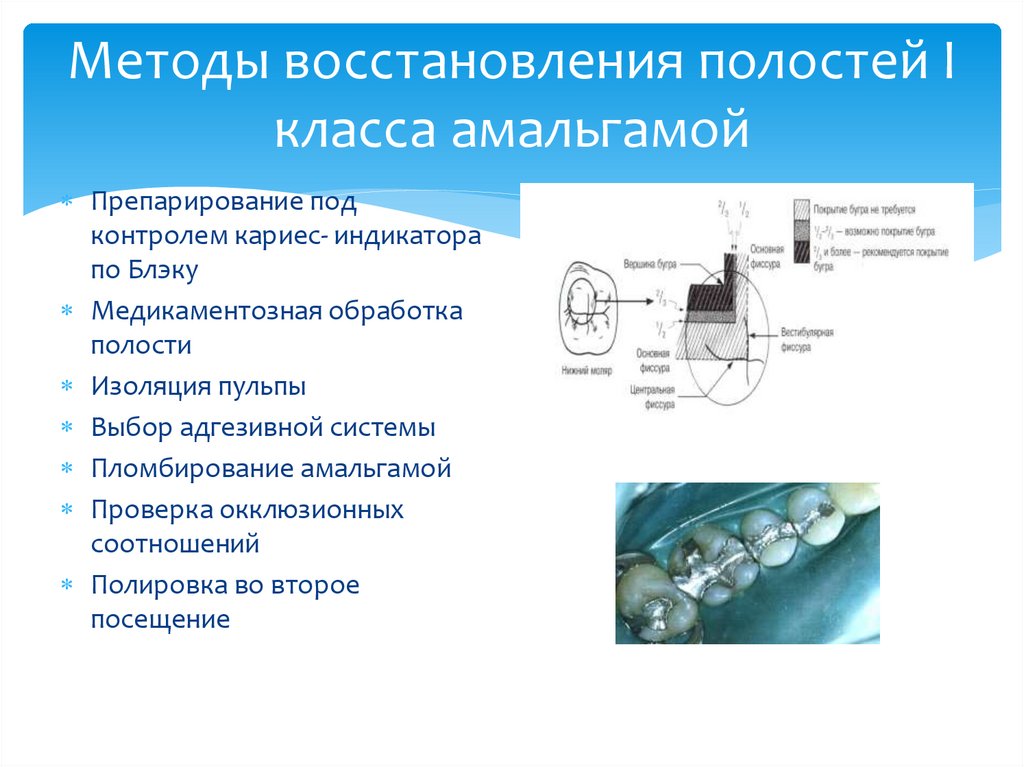 Методы восстановления полостей I класса амальгамой