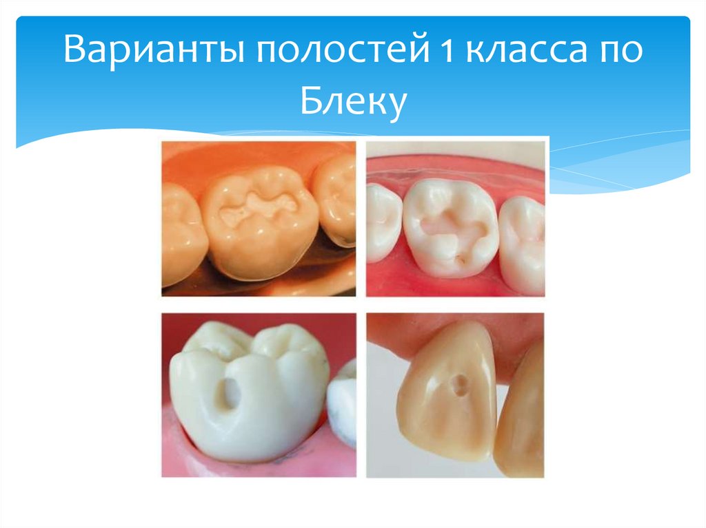 Варианты полостей 1 класса по Блеку