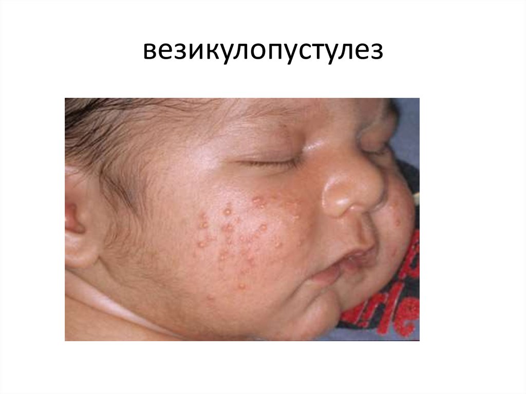 везикулопустулез