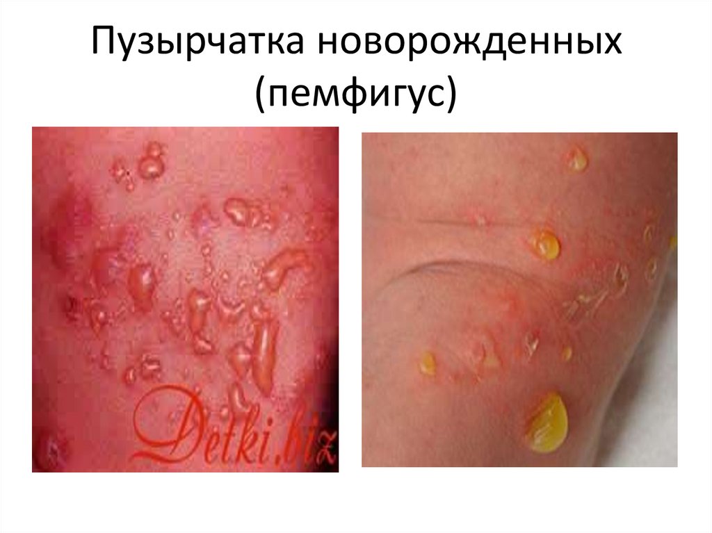 Пузырчатка новорожденных (пемфигус)