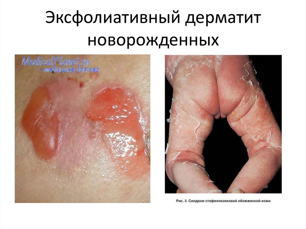 Эксфолиативный дерматит новорожденных