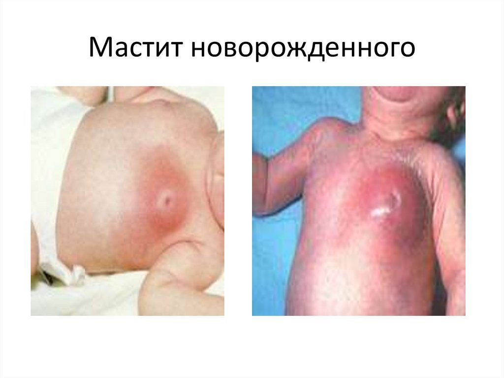 Мастит новорожденного