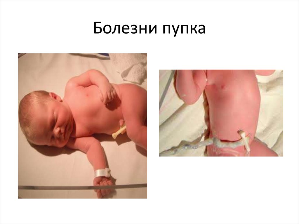 Болезни пупка