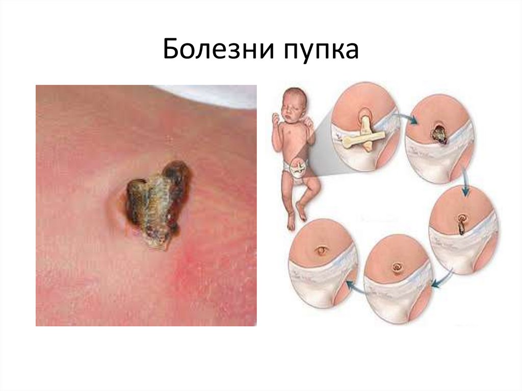 Болезни пупка