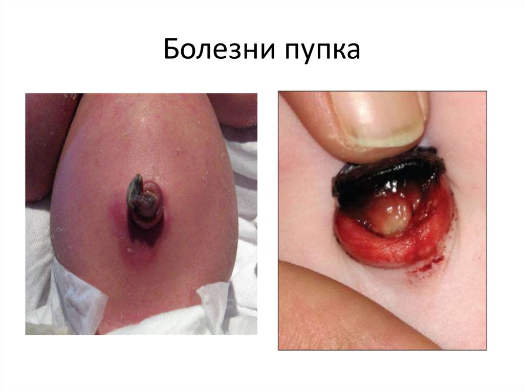 Болезни пупка