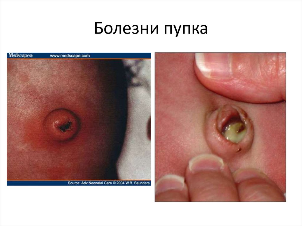 Болезни пупка