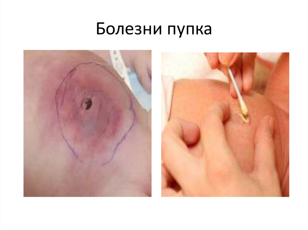 Болезни пупка