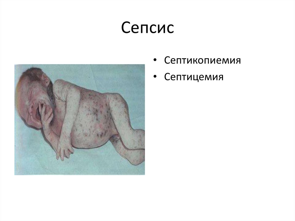 Сепсис
