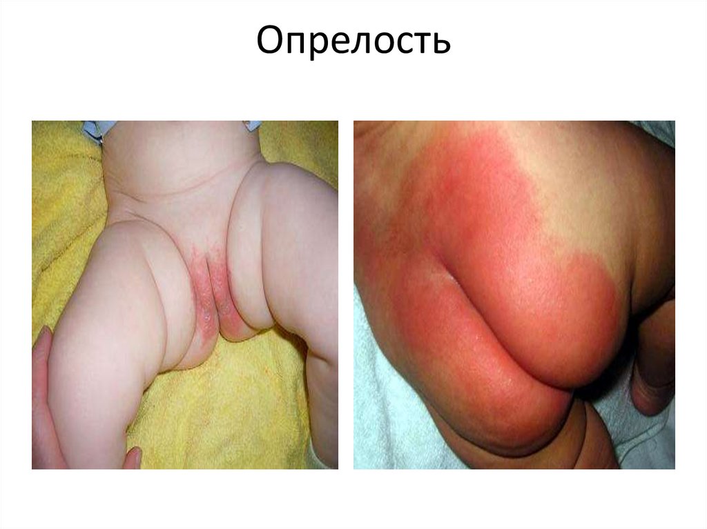 Опрелость