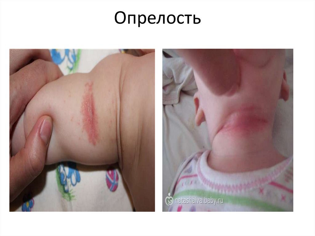 Опрелость