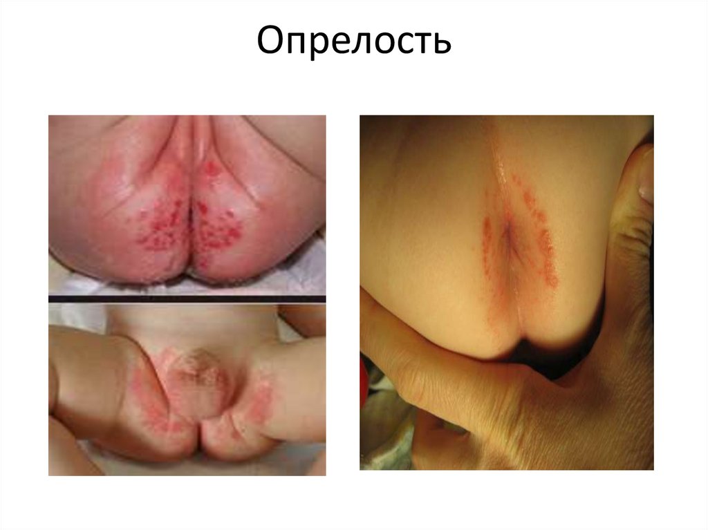 Опрелость