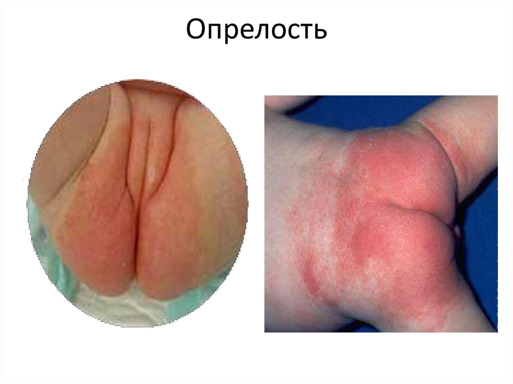 Опрелость