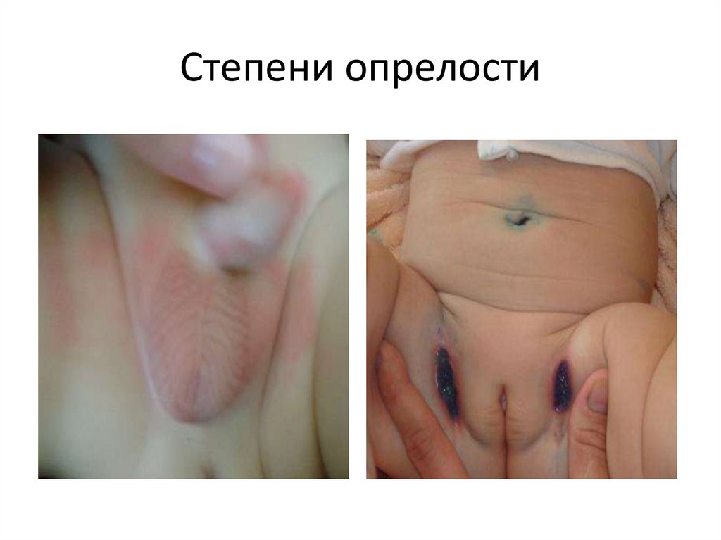 Степени опрелости