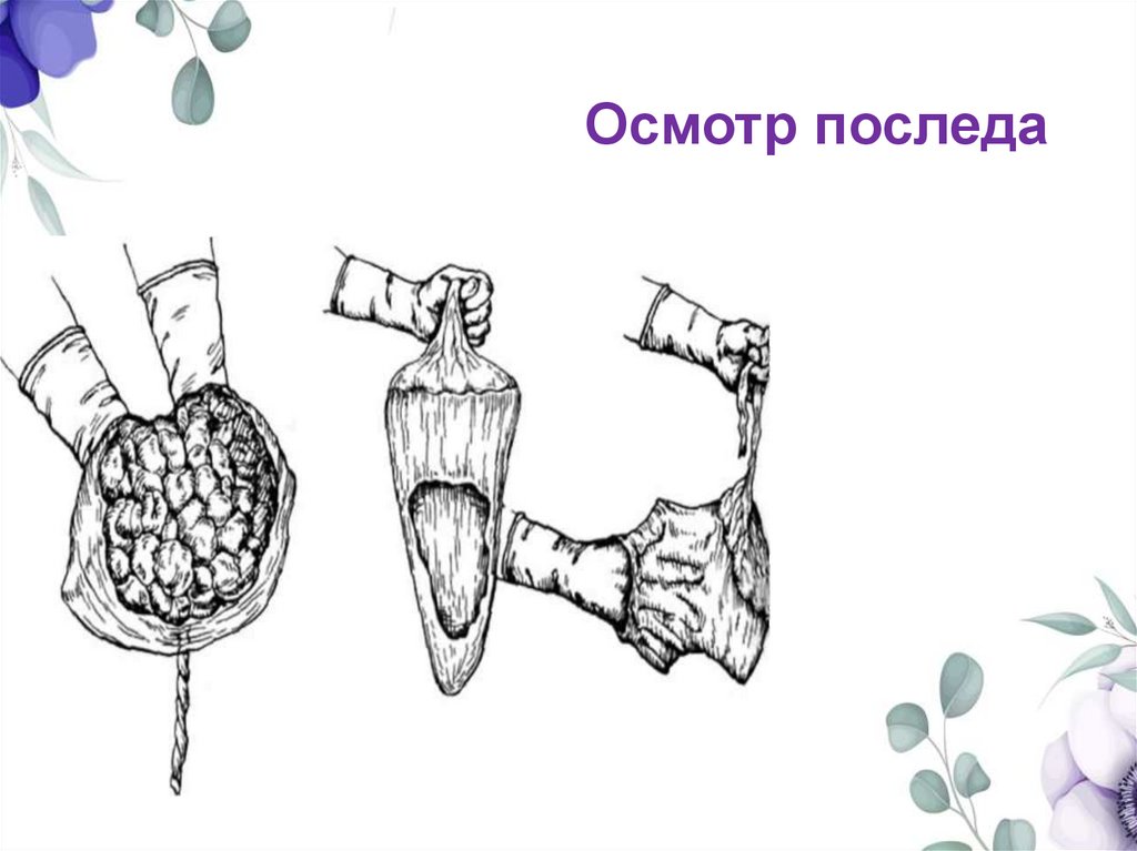 Осмотр последа