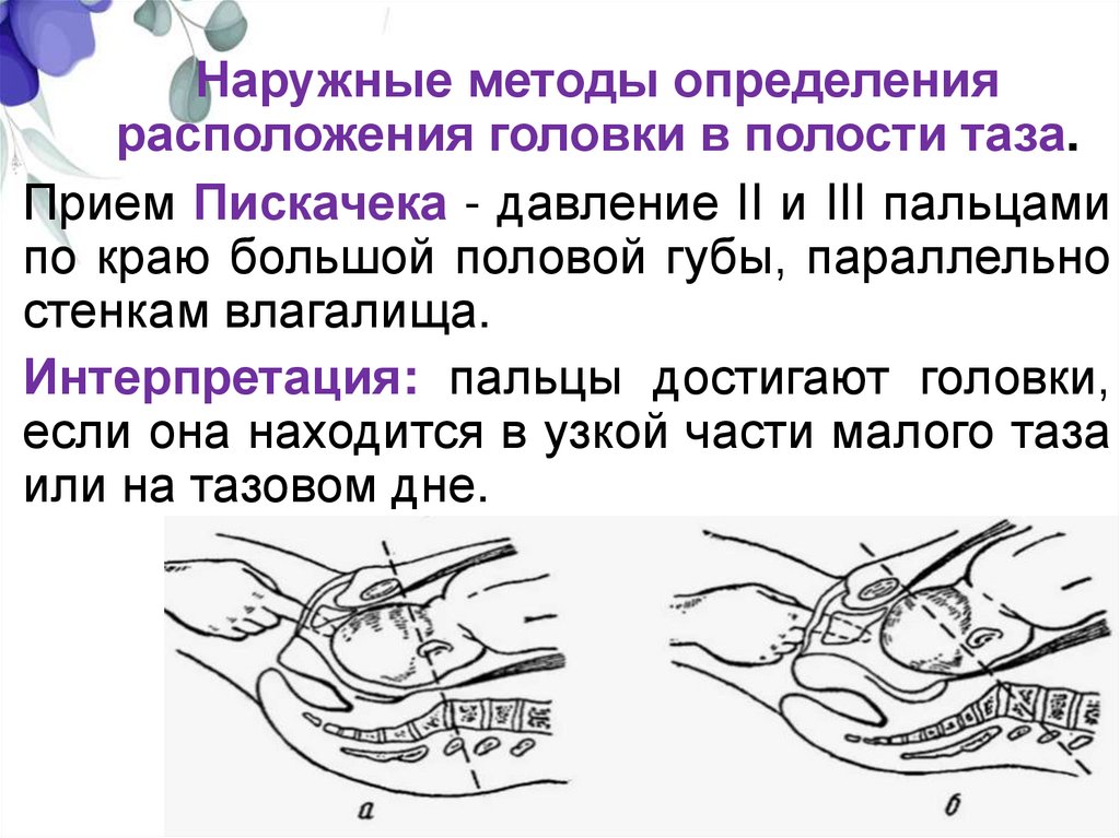 Наружные методы определения расположения головки в полости таза.
