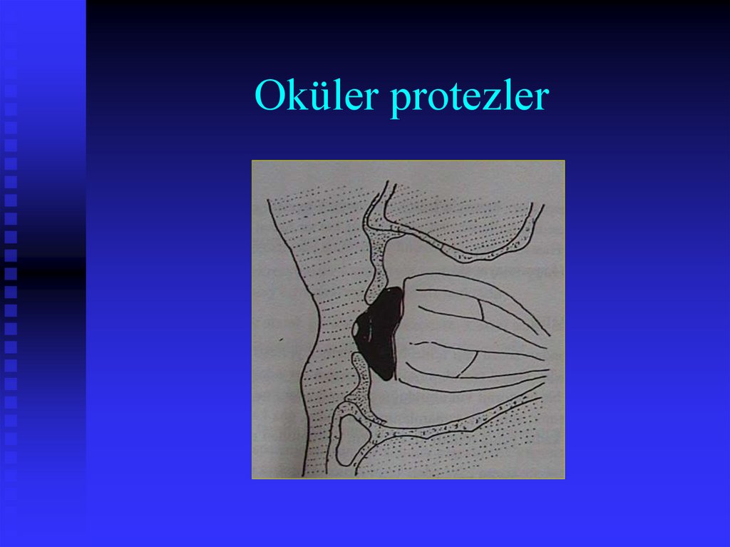 Oküler protezler