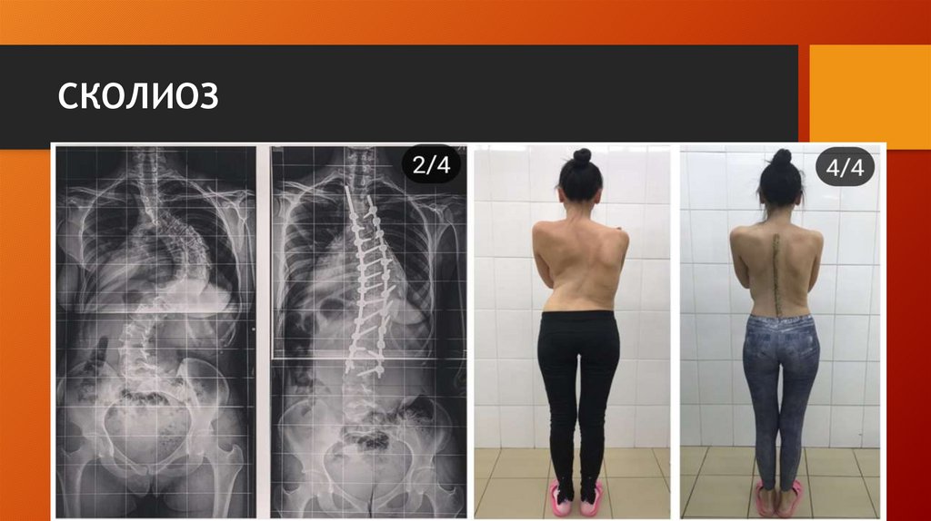 СКОЛИОЗ