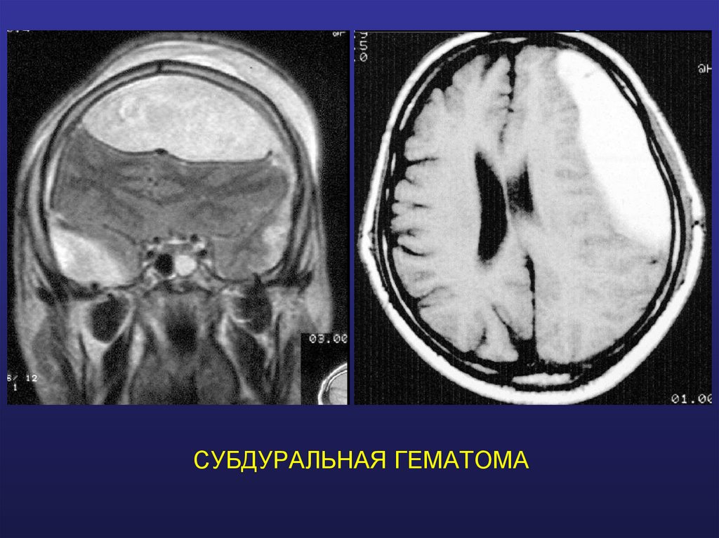 СУБДУРАЛЬНАЯ ГЕМАТОМА