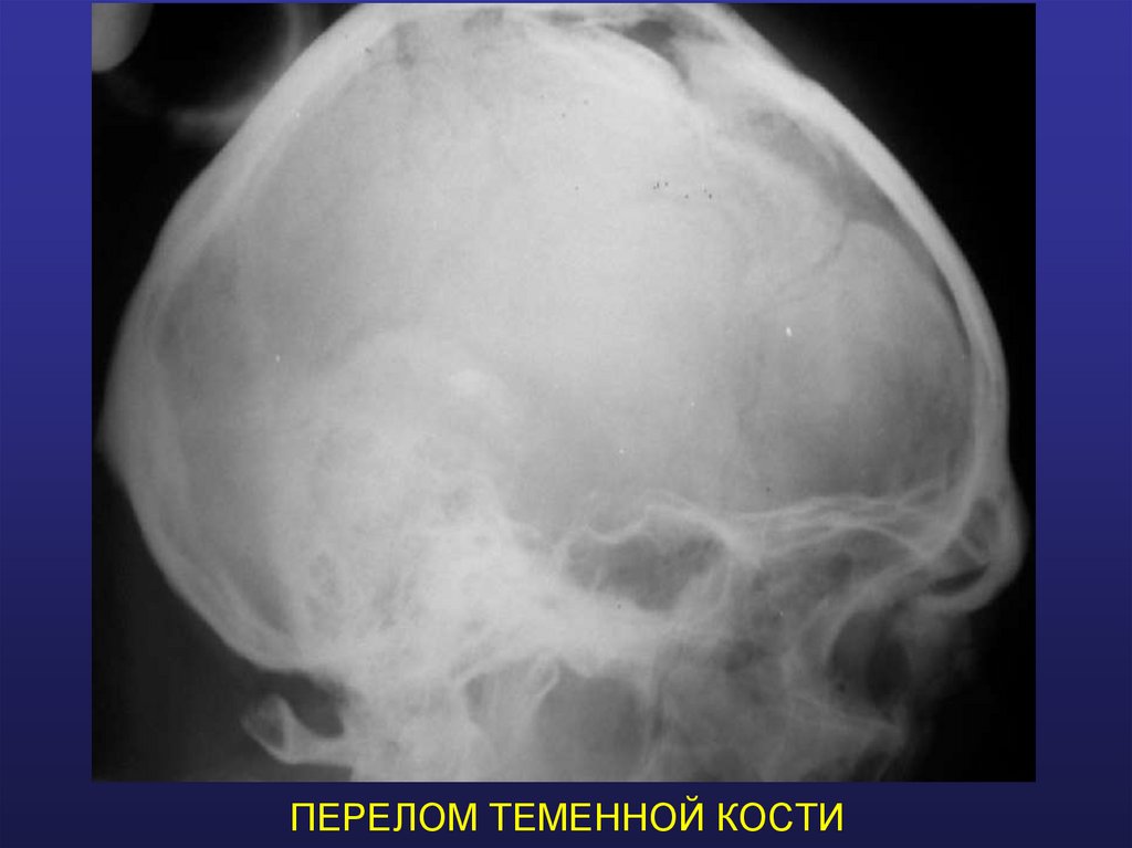 ПЕРЕЛОМ ТЕМЕННОЙ КОСТИ