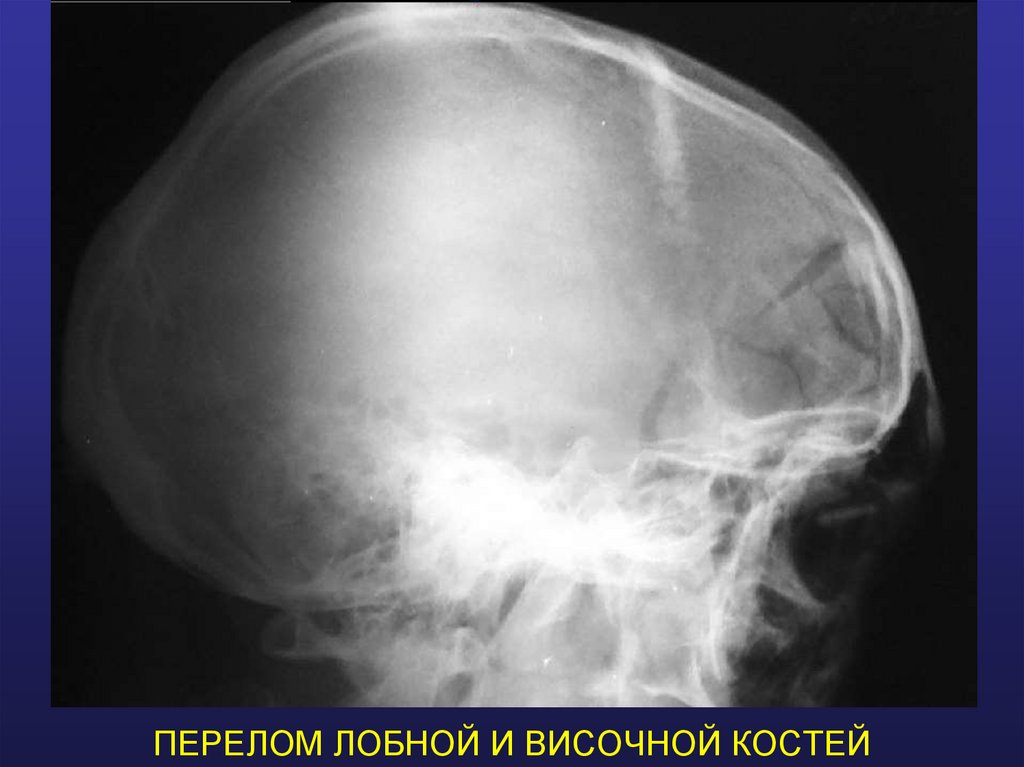 ПЕРЕЛОМ ЛОБНОЙ И ВИСОЧНОЙ КОСТЕЙ