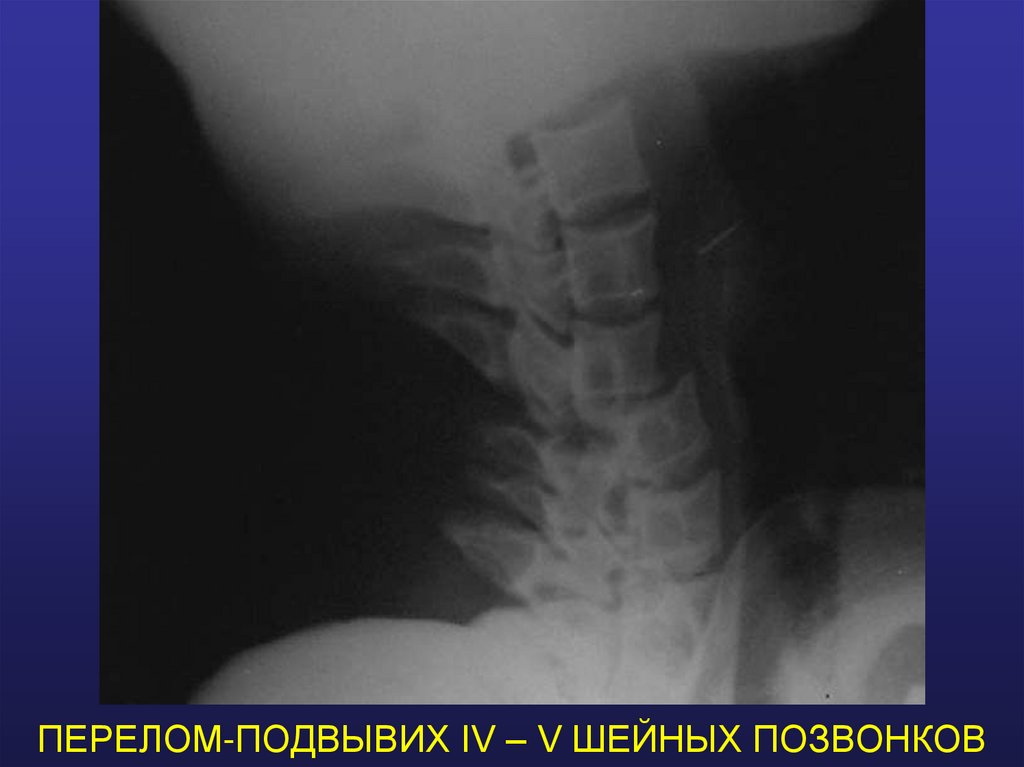 ПЕРЕЛОМ-ПОДВЫВИХ IV – V ШЕЙНЫХ ПОЗВОНКОВ