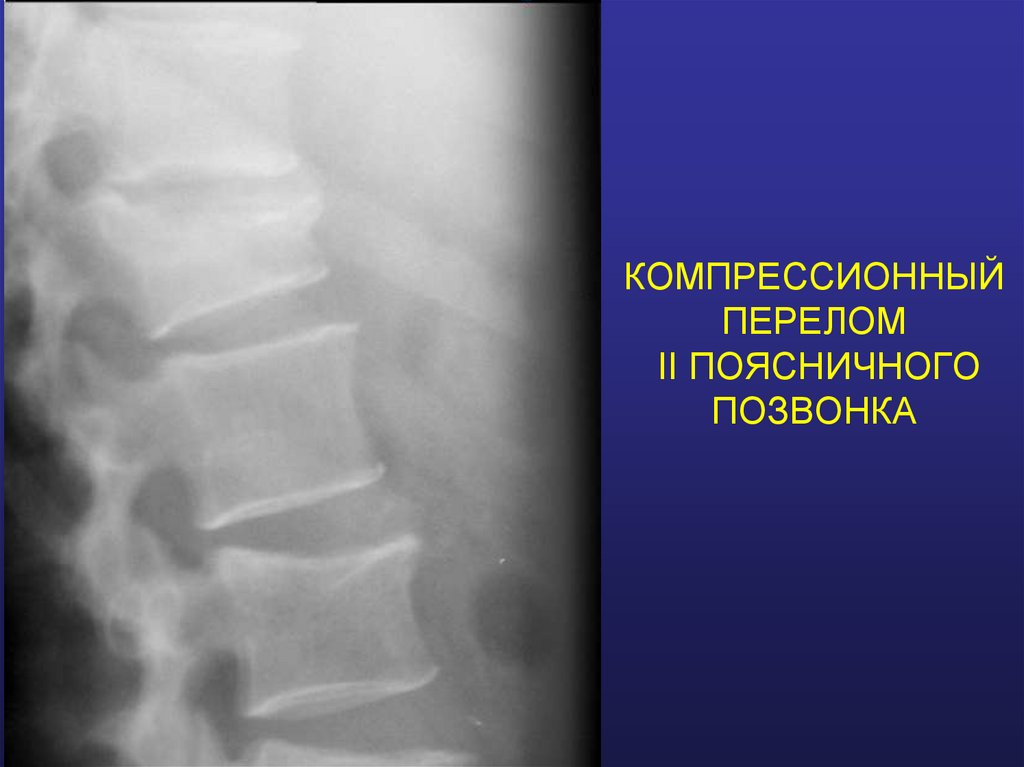 КОМПРЕССИОННЫЙ ПЕРЕЛОМ II ПОЯСНИЧНОГО ПОЗВОНКА