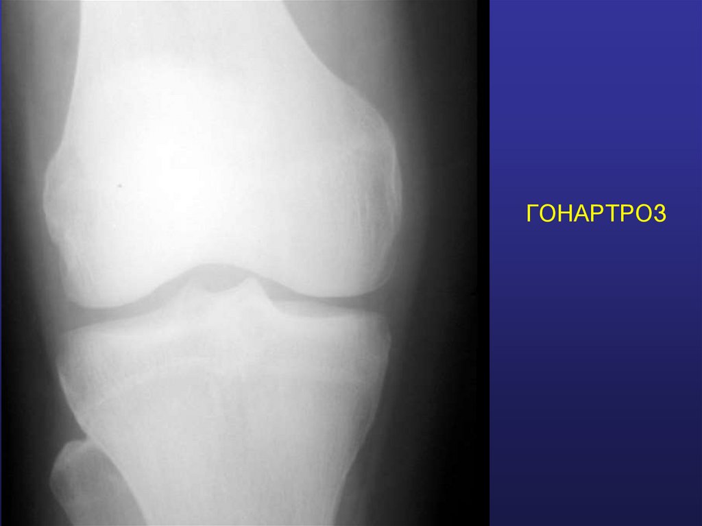 ГОНАРТРОЗ
