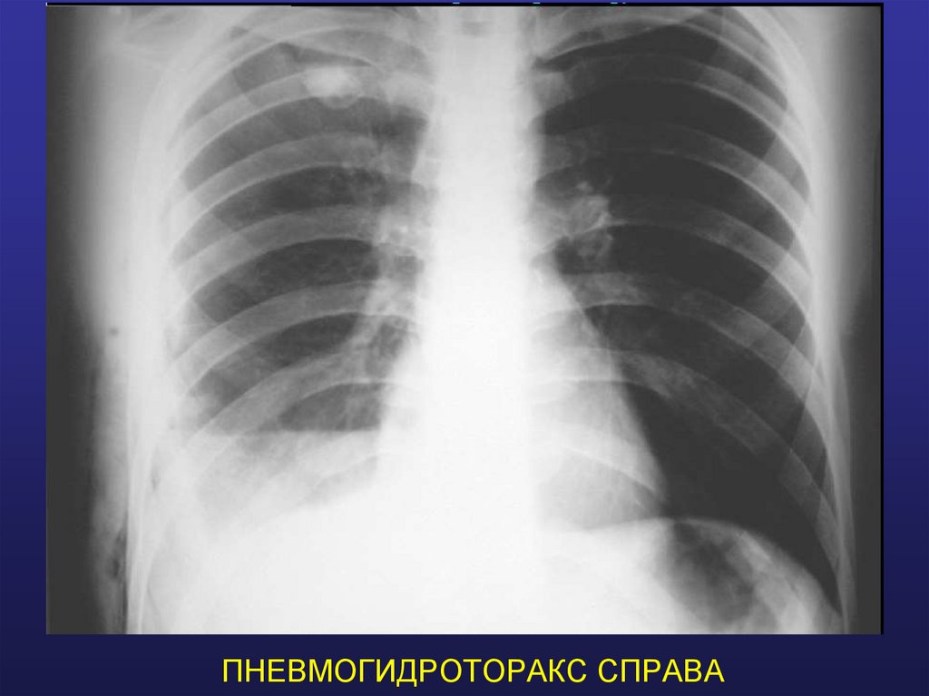 ПНЕВМОГИДРОТОРАКС СПРАВА