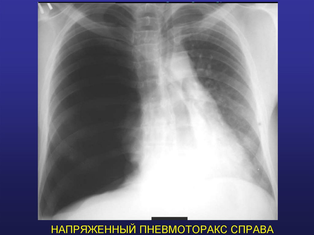 НАПРЯЖЕННЫЙ ПНЕВМОТОРАКС СПРАВА