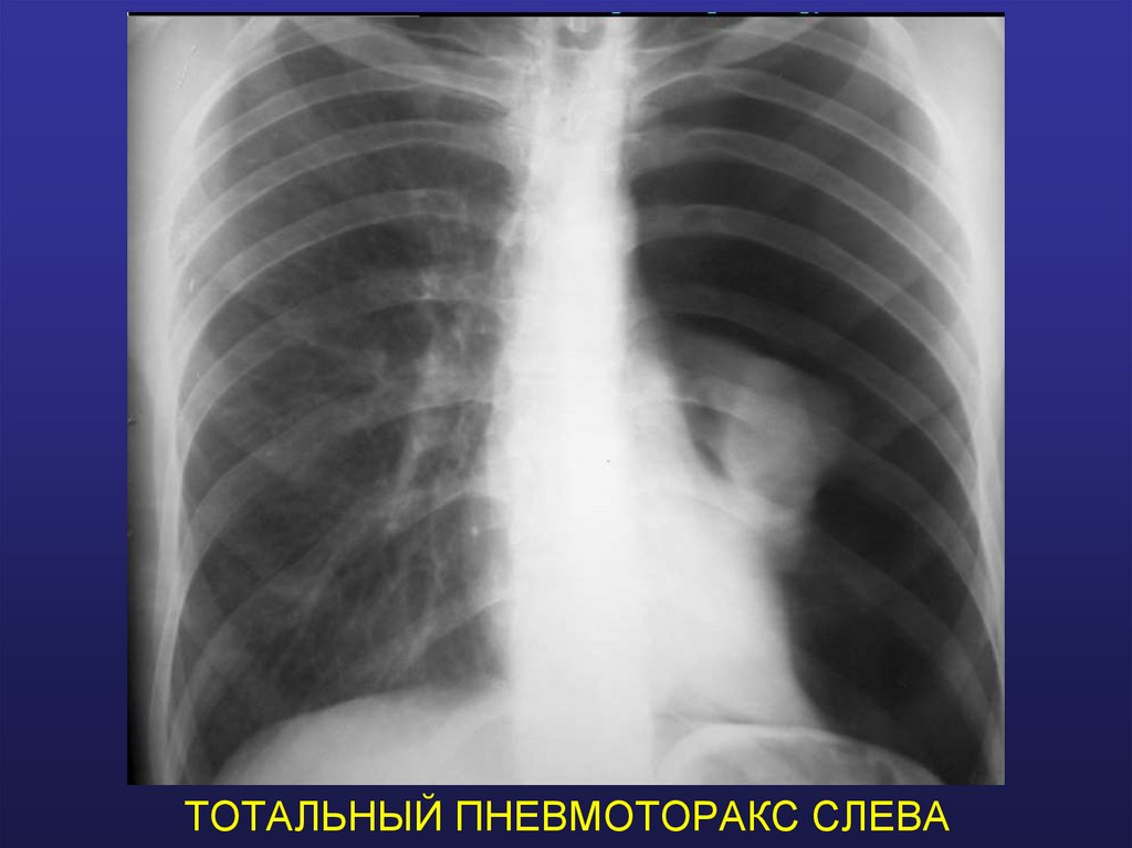 ТОТАЛЬНЫЙ ПНЕВМОТОРАКС СЛЕВА