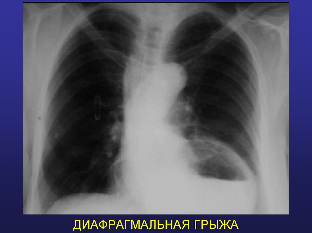 ДИАФРАГМАЛЬНАЯ ГРЫЖА