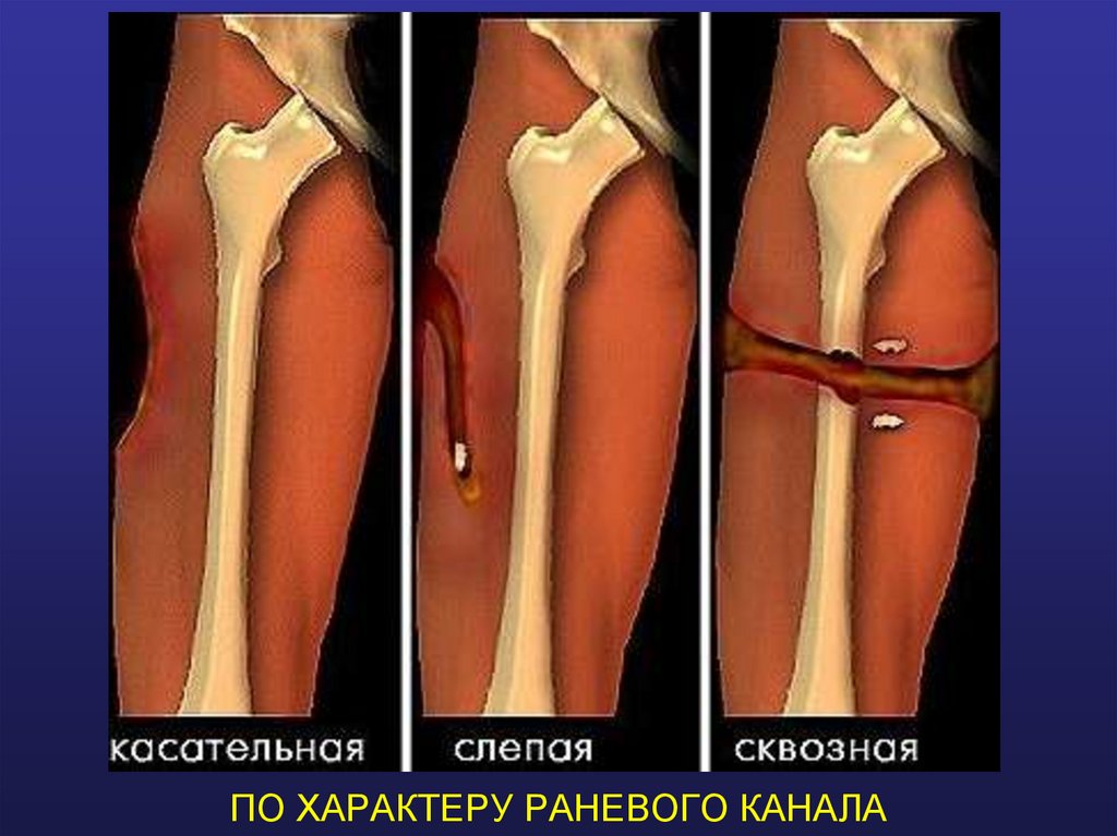 ПО ХАРАКТЕРУ РАНЕВОГО КАНАЛА