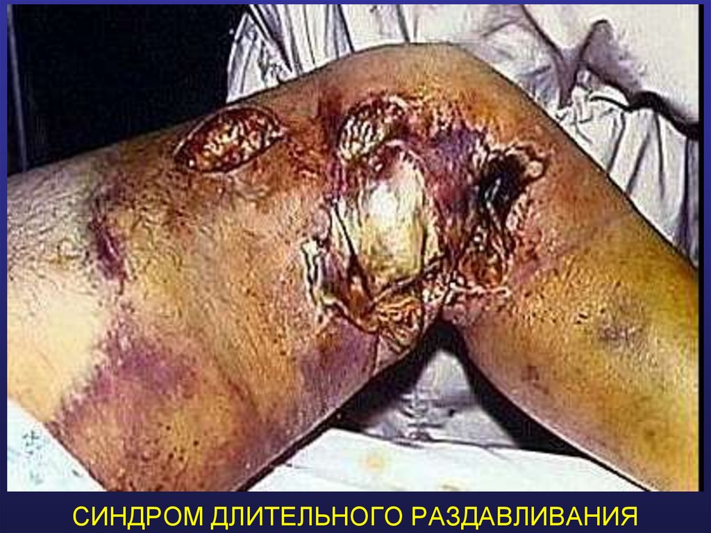 СИНДРОМ ДЛИТЕЛЬНОГО РАЗДАВЛИВАНИЯ