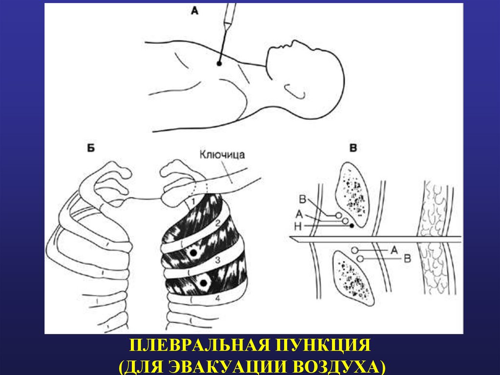 ПЛЕВРАЛЬНАЯ ПУНКЦИЯ (ДЛЯ ЭВАКУАЦИИ ВОЗДУХА)